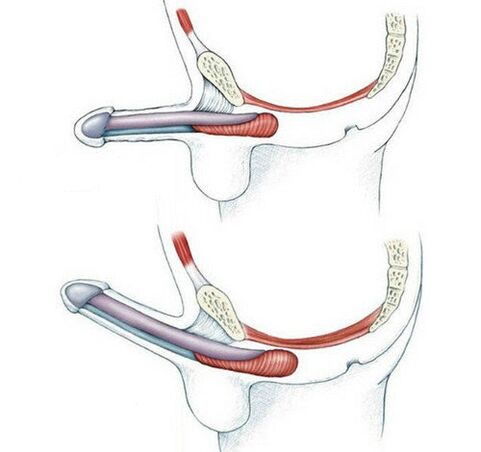 Pénis sans entraînement des muscles pubococcygiens et après