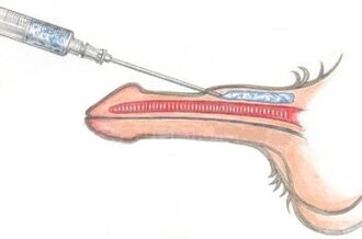 Une méthode dangereuse d’agrandissement du pénis par injections de vaseline